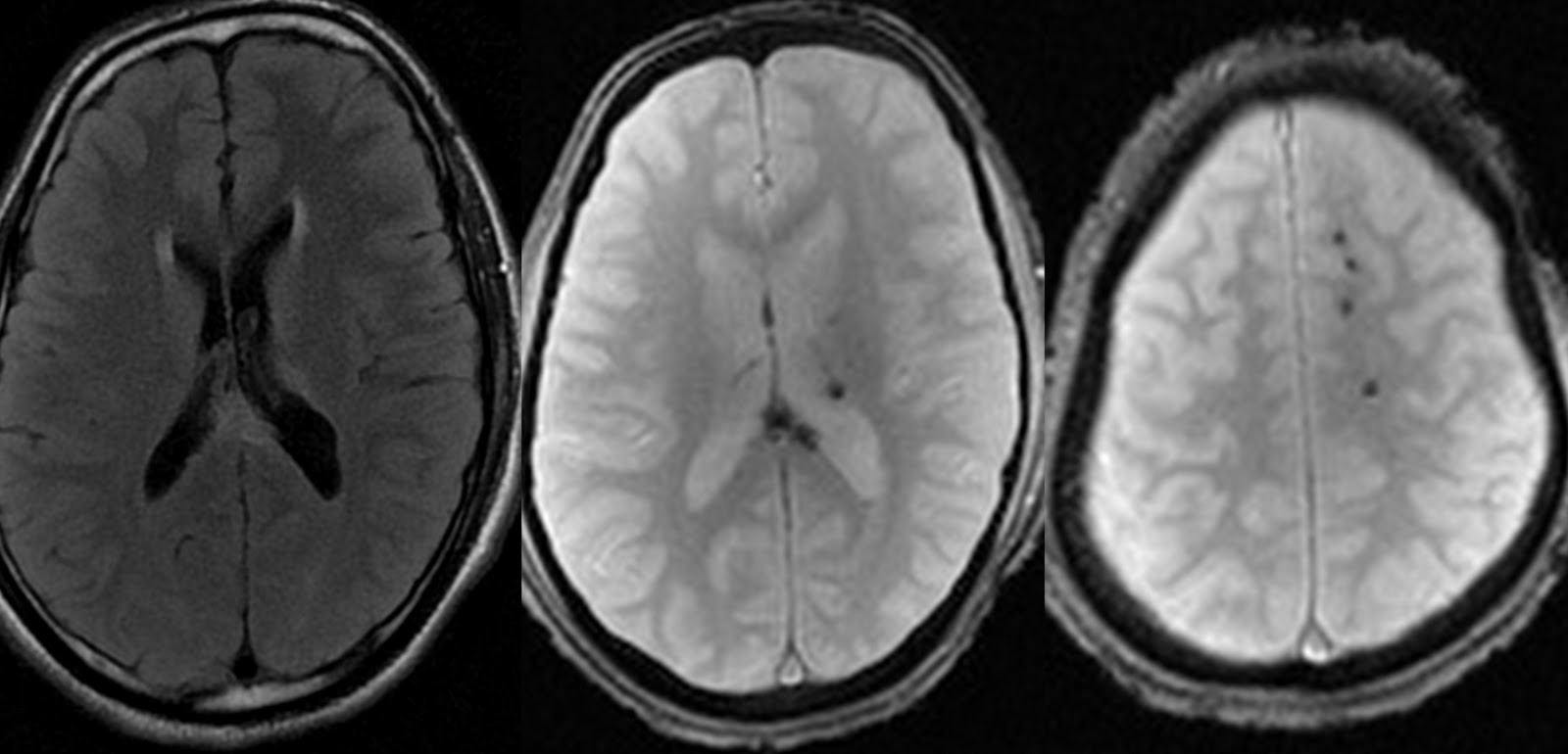 Mri Brain: Gradient Echo Sequence Mri Brain